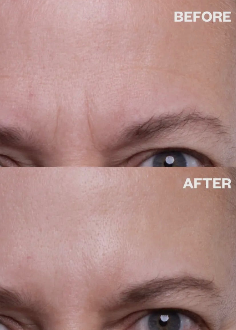 Forehead Wrinkle Patches