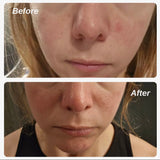 10% Azelaic Acid Redness Calming Cream