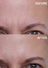 Forehead Wrinkle Patches