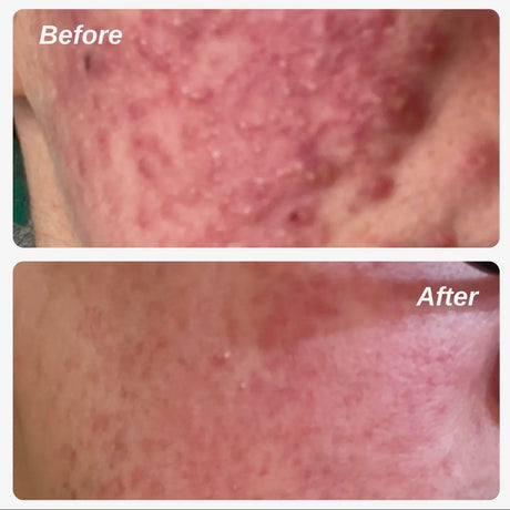 10% Azelaic Acid Redness Calming Cream